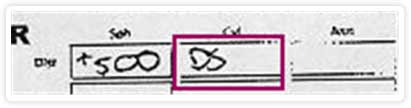 No astigmatism example